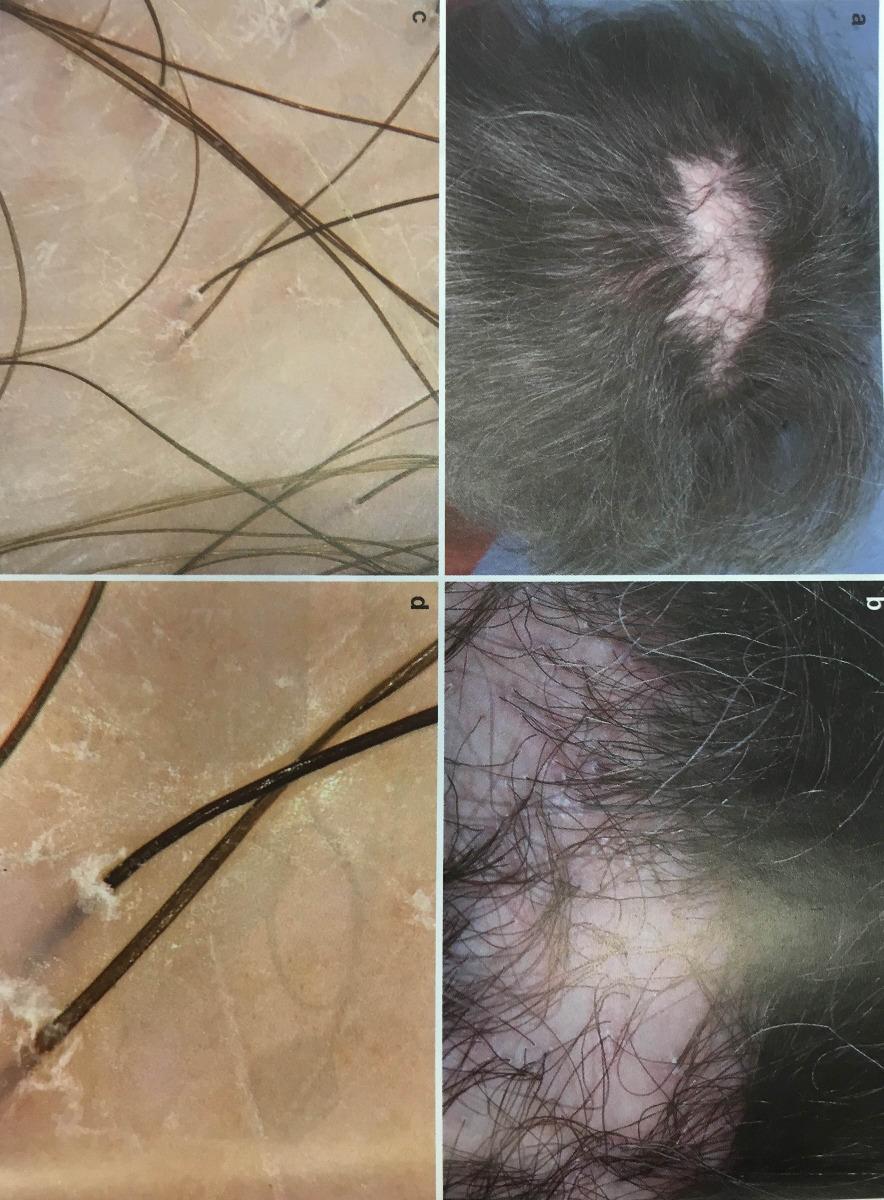 Trichoscopie (observation des cheveux et du cuir chevelu) à Istres