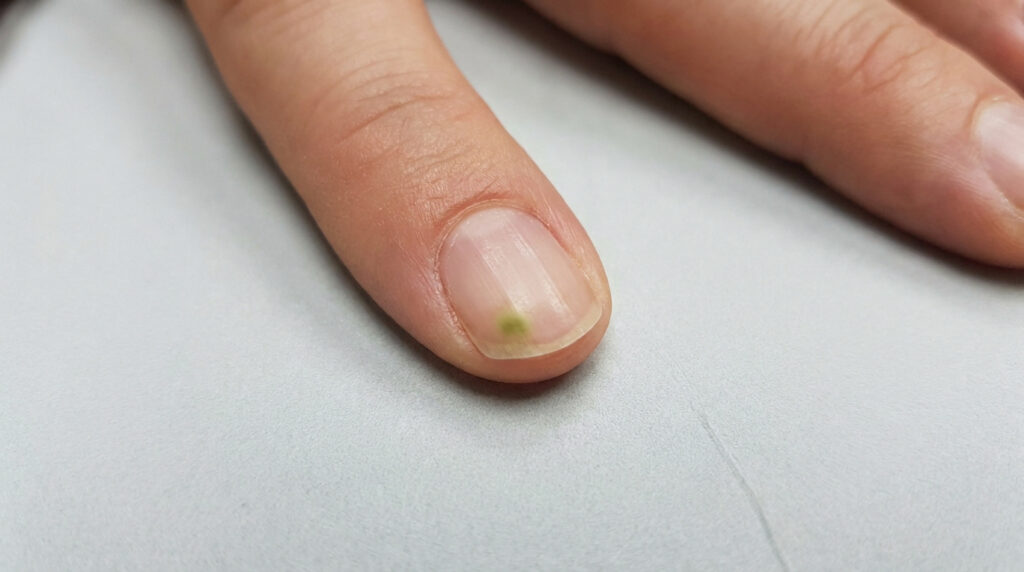 Gros plan sur un ongle de doigt présentant une tache verte caractéristique d'une infection bactérienne.