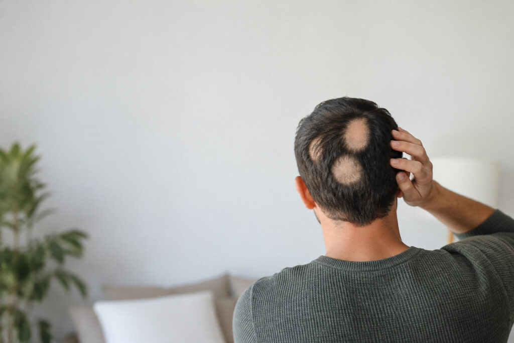 Vue arrière d'un homme aux cheveux sombres montrant deux zones circulaires de perte de cheveux sur le cuir chevelu.